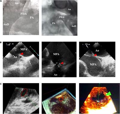 Echocardiography-Guided Percutaneous Patent Ductus Arteriosus Closure: 1-Year Single Center Experience in Indonesia